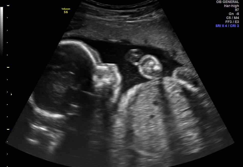 23 week ultrasound picture